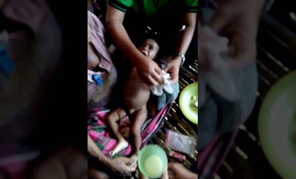 Bertambah Korban Campak dan Gizi Buruk di Asmat