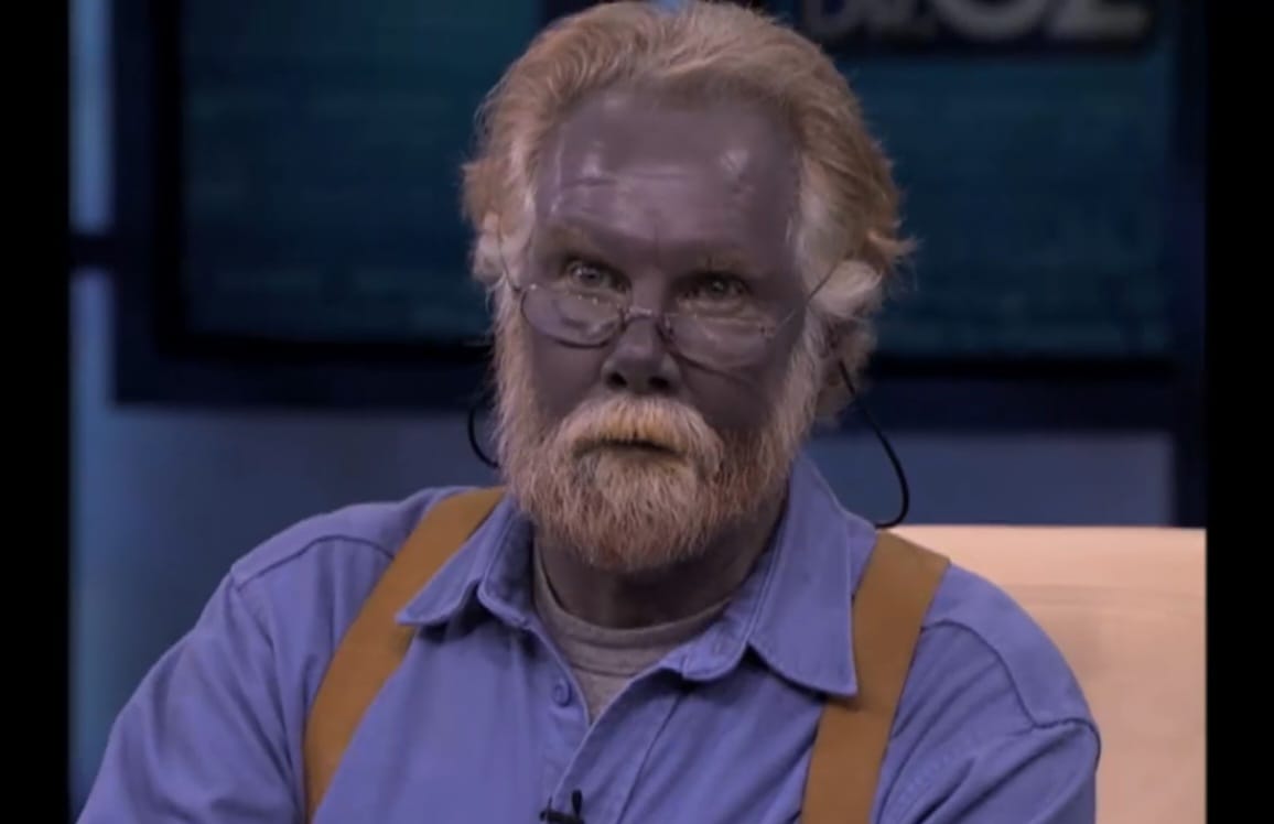Argyria, Penyakit Langka yang Mengubah Kulit Penderitanya Menjadi Biru