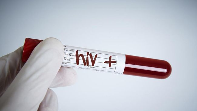 Sejarah dan Perkembangan HIV/AIDS di Dunia dan Indonesia